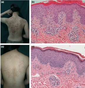 J Eur Acad Dermatol Venereol. 2012 Sep;26(9):1149-53Oh YJ, Lee MH.