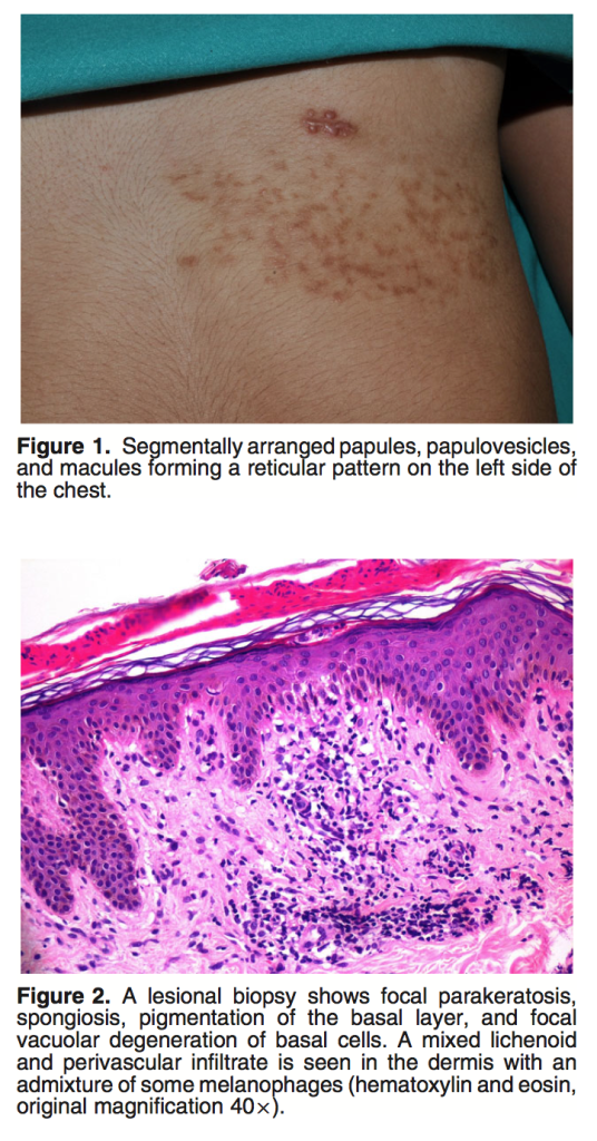 Prurigo Pigmentosa Literature Review Part 2 – A Segmental Appearance ...